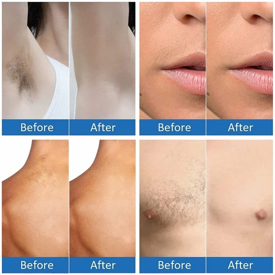 Merkloos Ontharingsapparaat Voor Vrouwen & Mannen ,duurzame Ontharing ,Duurzame Nud Pijnloze Ontharing 7 Merkloos Ontharingsapparaat Voor Vrouwen & Mannen ,duurzame Ontharing ,Duurzame Nud Pijnloze Ontharing - Afbeelding 7