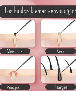 Viamart - Ultrafijn Pincet - Los Eenvoudig Huidproblemen Op: Acne, Mee-eters, Haartjes, Puistjes, Splinters En Teken 2 Viamart - Ultrafijn Pincet - Los Eenvoudig Huidproblemen Op: Acne, Mee-eters, Haartjes, Puistjes, Splinters En Teken -Philips winkel 550x550 142
