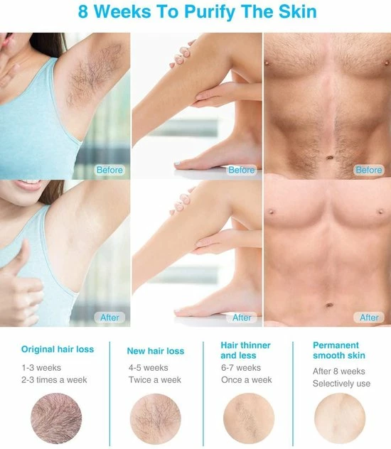 IPL Ontharingsapparaat, Thuisgebruik IPL Haarverwijderaar 999,999 Lichtimpuls & 3 Cm Ontharingsgrootte, Duurzame Ontharingsapparaat Laser Voor Lichaam, Gezicht, Bikinizone, Intieme Delen 2 IPL Ontharingsapparaat, Thuisgebruik IPL Haarverwijderaar 999,999 Lichtimpuls & 3 Cm Ontharingsgrootte, Duurzame Ontharingsapparaat Laser Voor Lichaam, Gezicht, Bikinizone, Intieme Delen - Afbeelding 2